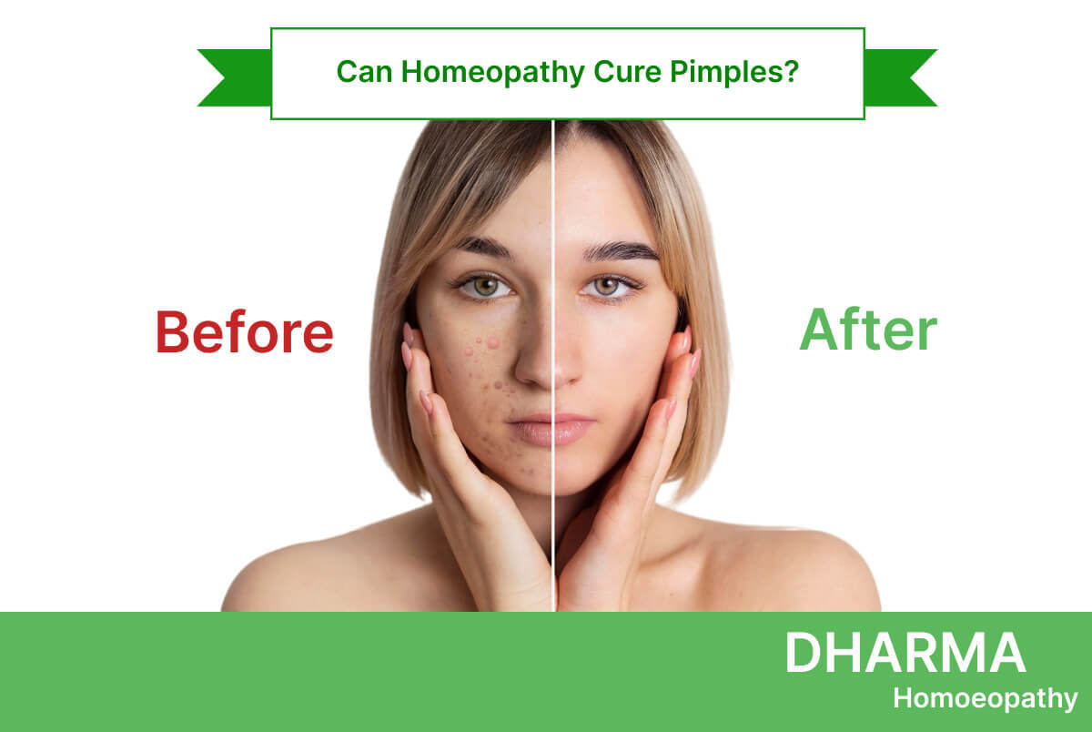 Before-and-after-pimples