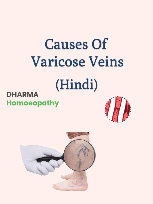 Read more about the article Causes of Varicose Veins